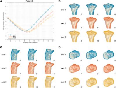 A preoperative simulation of medial open-wedge high tibial osteotomy for predicting postoperative realignment
